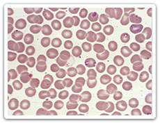 Babesia microti dans le frottis de sang périphérique