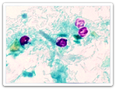 Cryptosporidium (Cryptosporidiosis)