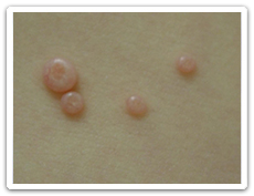 Molluscum Contagiosum